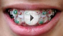Brace Yourself: Wearing Braces For Teeth is a New Fashion