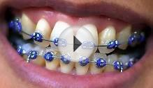 Fake Braces Worn as a Fashion Trend in Asian Countries [VIDEO]